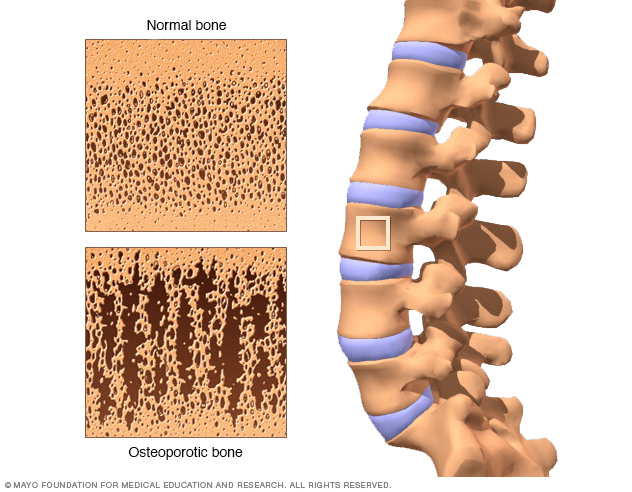 Comparing the interior of a healthy bone with one that has become porous from osteoporosis