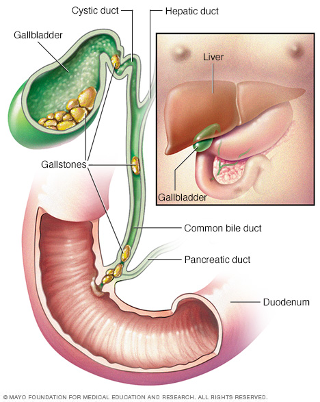 Gallbladder and gallstones