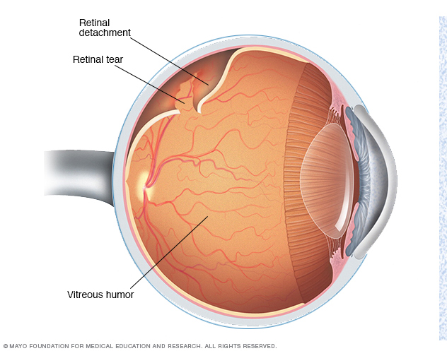 Retinal detachment