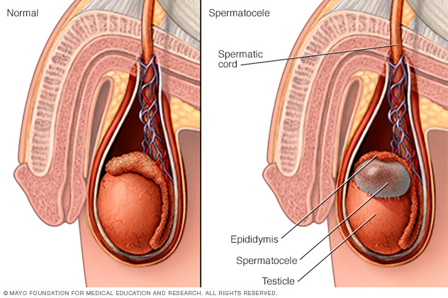 Spermatocele