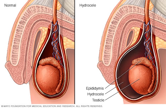 Hydrocele