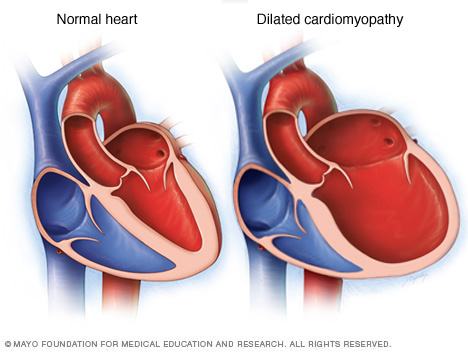 Dilated cardiomyopathy