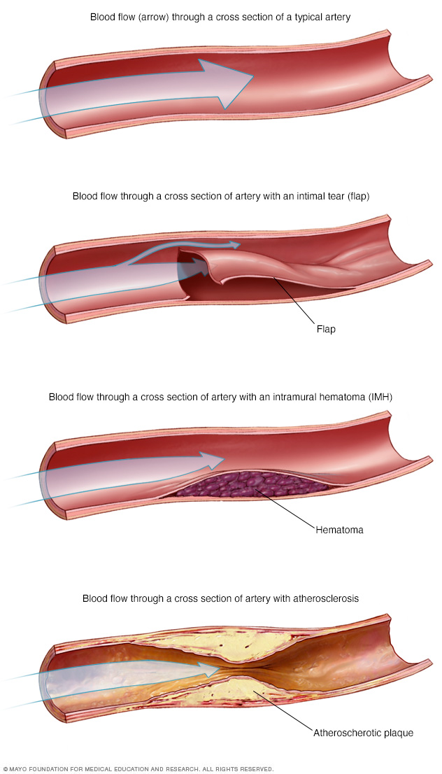 Blood flow in arteries in SCAD