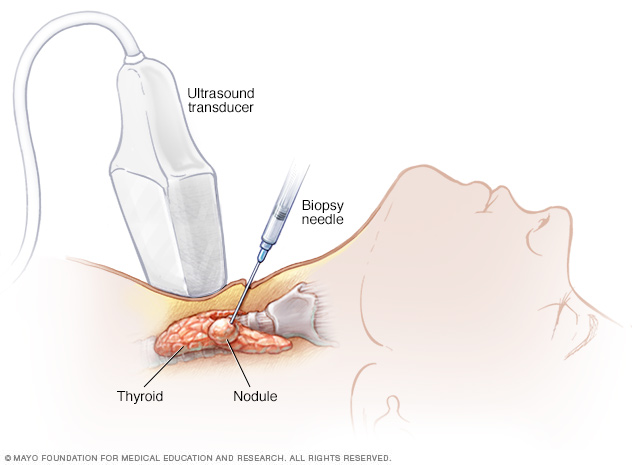 Needle biopsy of thyroid cancer