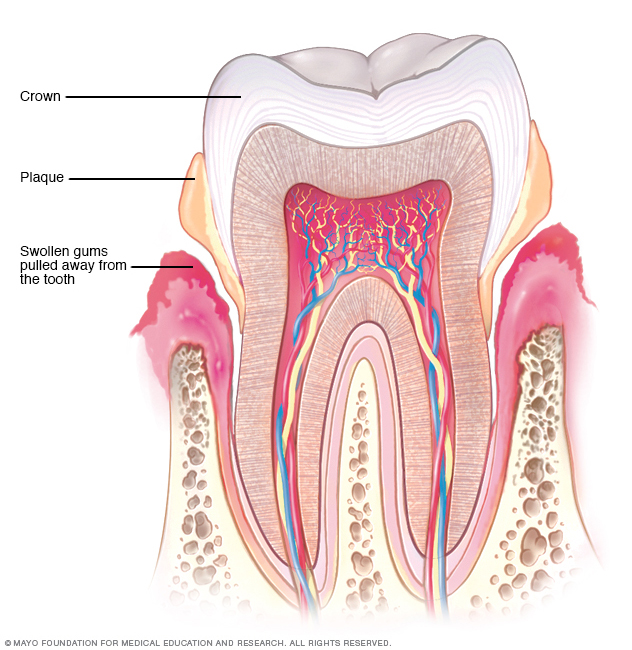 Periodontitis