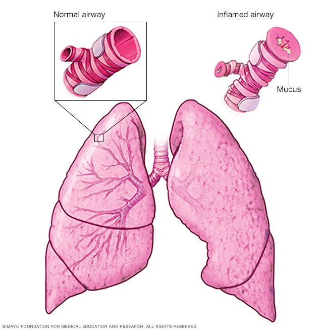 What happens during an asthma attack