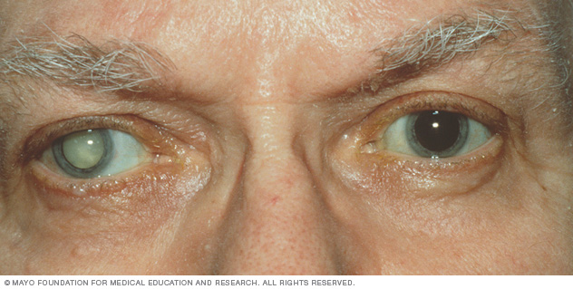 A person with a cataract