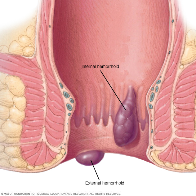 Hemorrhoids