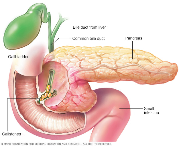 Pancreatitis caused by gallstones