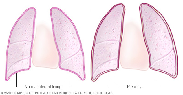 Healthy pleural lining and pleurisy