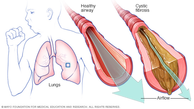 Normal airway versus airway with cystic fibrosis