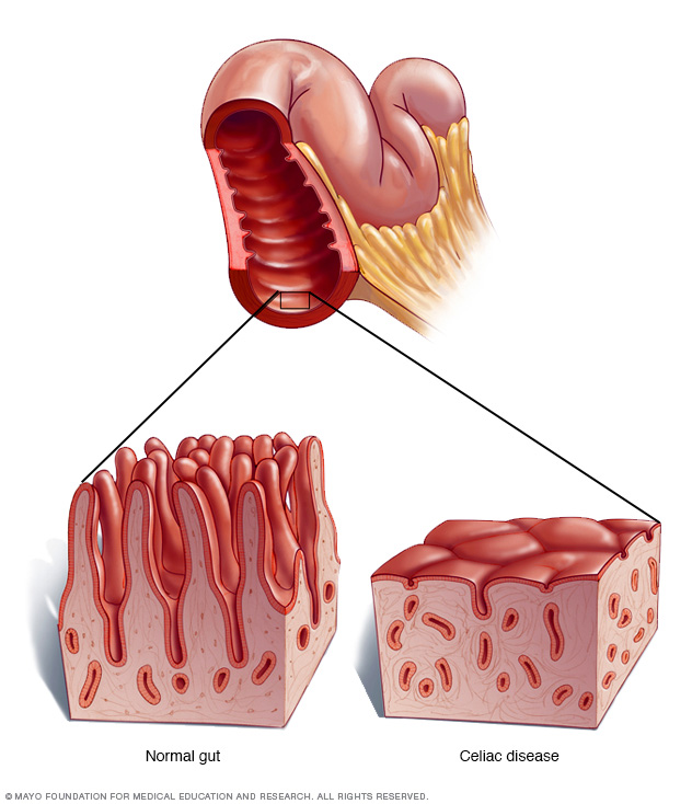 Celiac disease