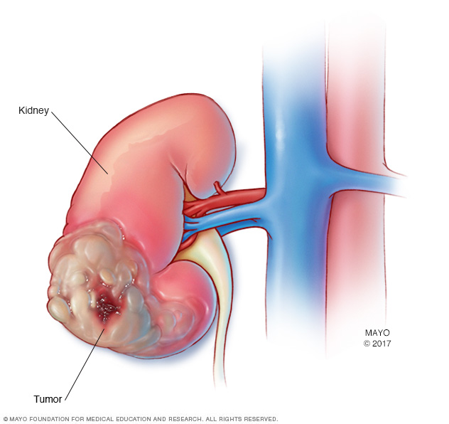 Kidney cancer 