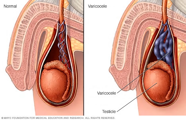 Varicocele