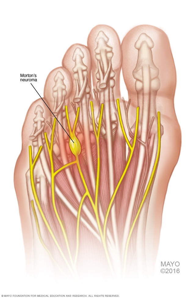 Morton's neuroma 
