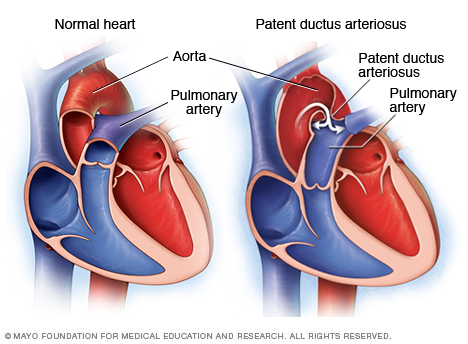 Patent ductus arteriosus