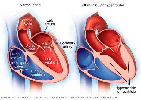 Left ventricular hypertrophy