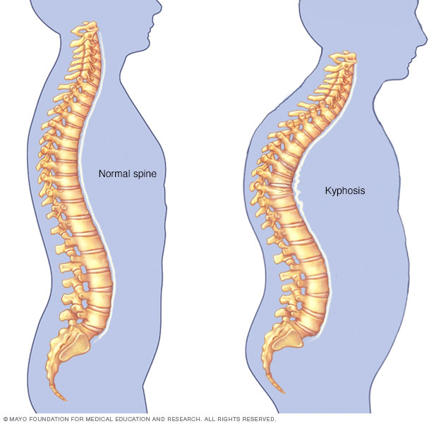 Kyphosis