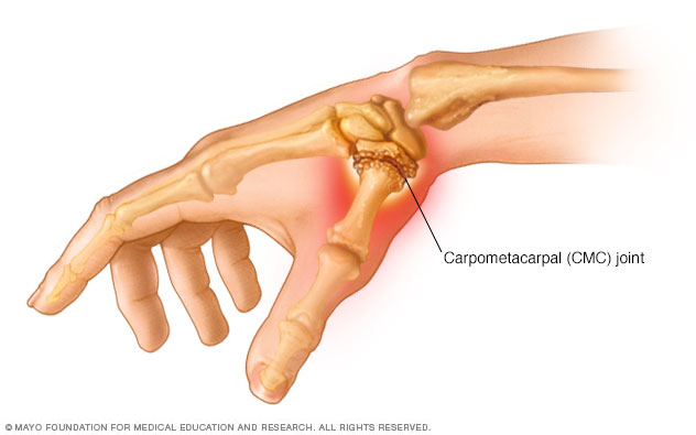 Thumb arthritis
