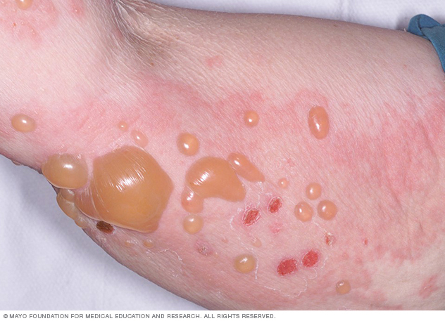 Bullous pemphigoid 