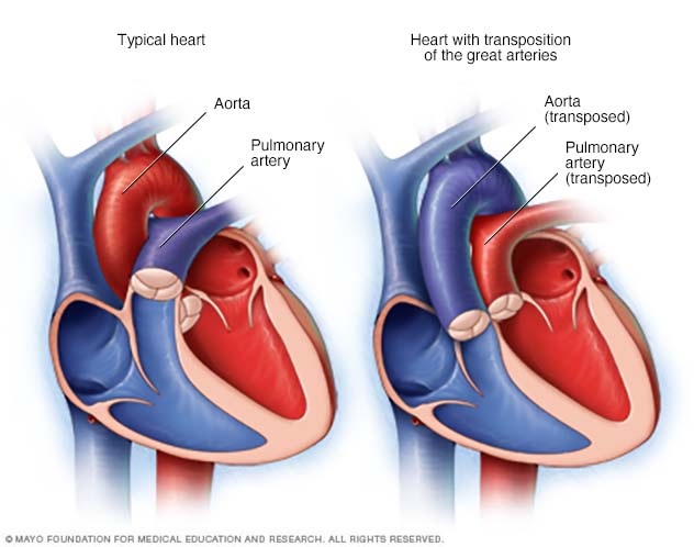 Transposition of the great arteries