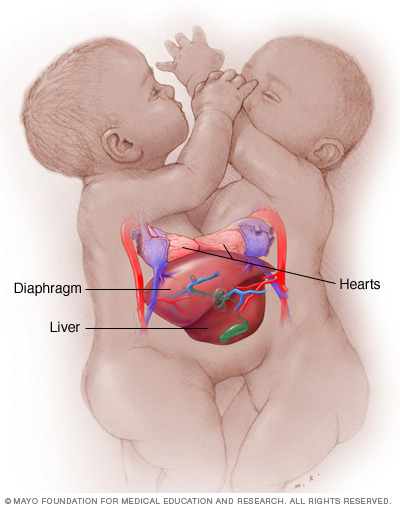 Conjoined twins 