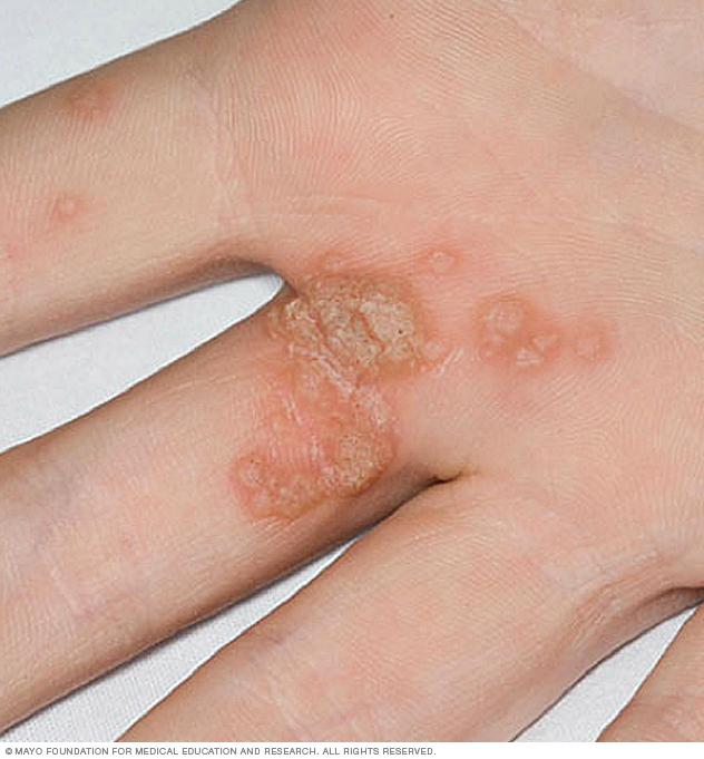 Common warts on hand