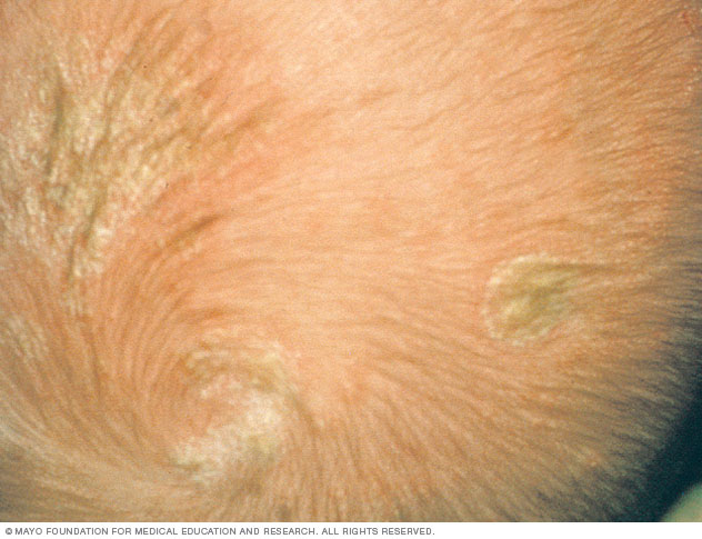 Cradle cap on white skin