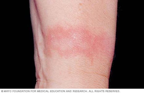 Contact dermatitis on four different skin colors.