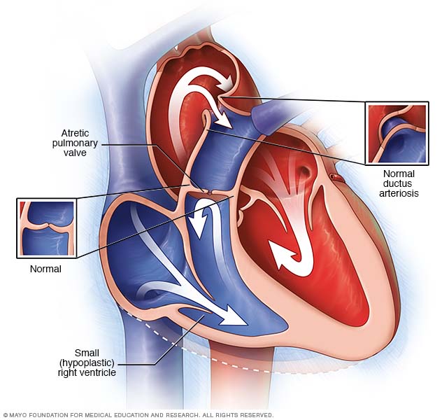 Pulmonary atresia