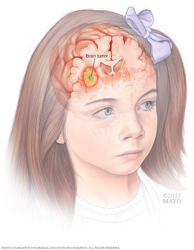 Brain tumor in child