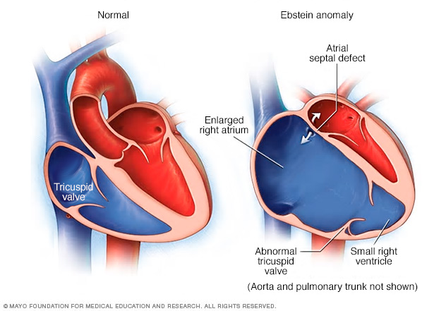 Ebstein anomaly