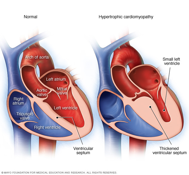 Typical heart and heart with hypertrophic cardiomyopathy