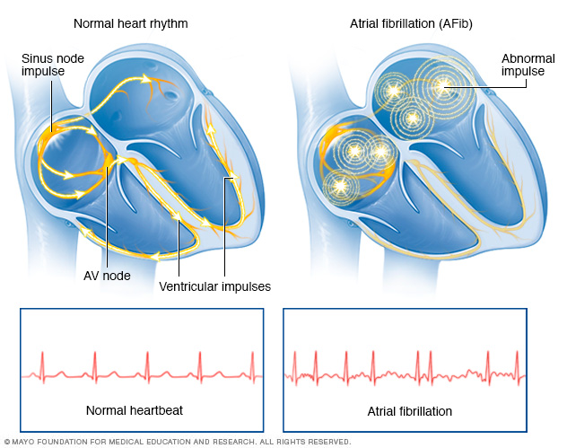 Atrial fibrillation