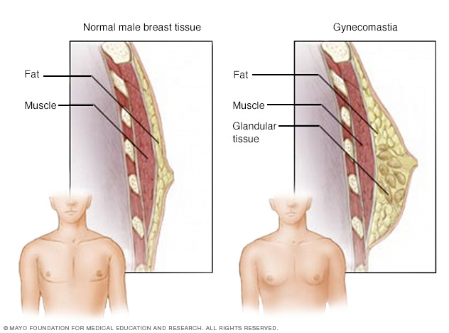 Enlarged breasts in men (gynecomastia)