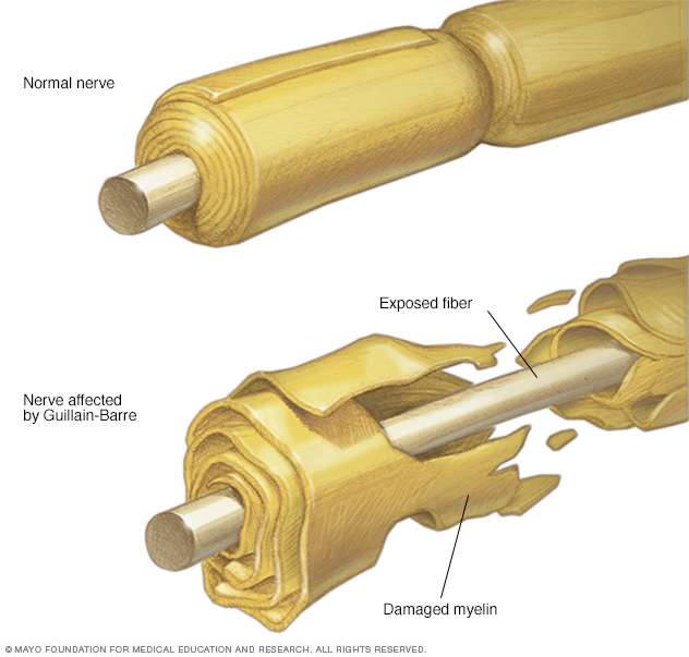 Nerve and damaged myelin sheath