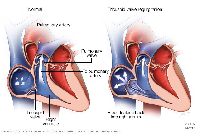 Tricuspid valve regurgitation