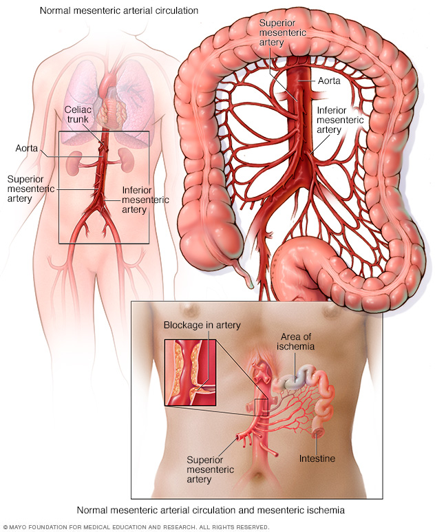 Typical mesenteric arterial circulation and mesenteric ischemia