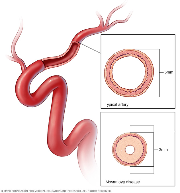 Illustration of moyamoya disease