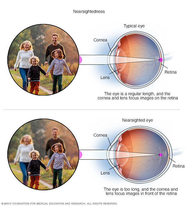 Nearsightedness