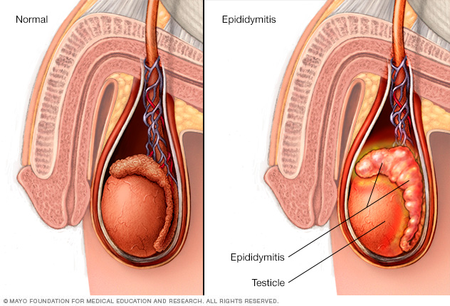 Scrotum, testicle and epididymis