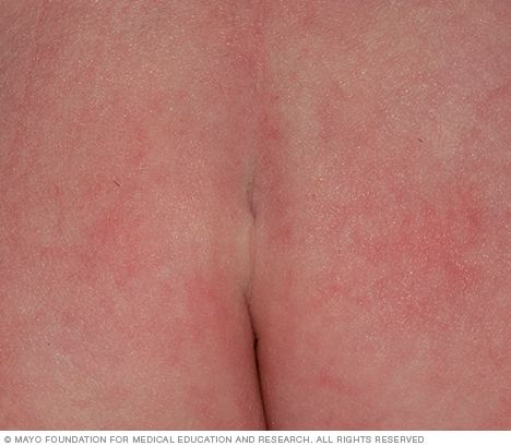 A pit in the skin above the crease between the buttocks is usually harmless.