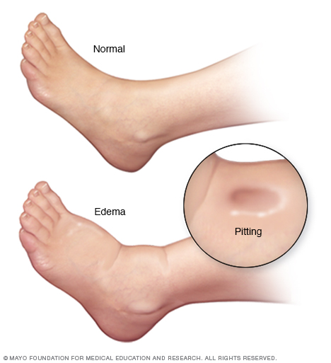 Edema in foot and ankle