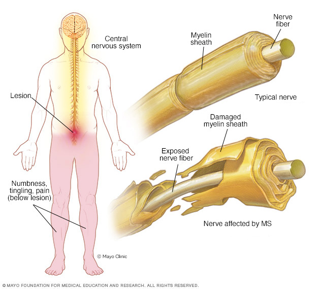 MS-related nervous system damage