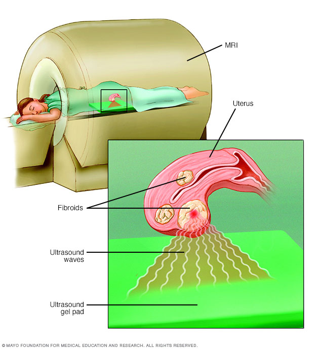 Focused ultrasound surgery for treatment of uterine fibroids