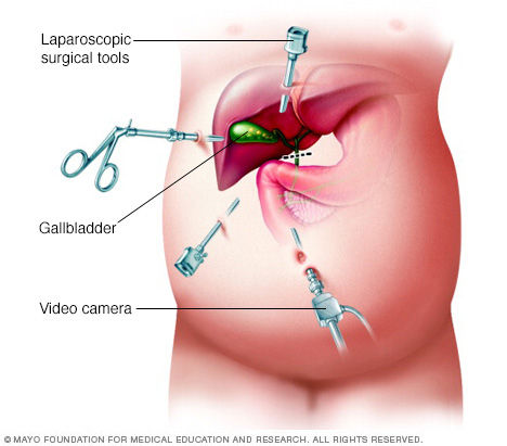 Laparoscopic cholecystectomy