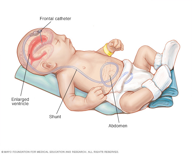 Shunt system 