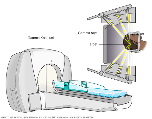 Gamma rays delivering radiation to the head.