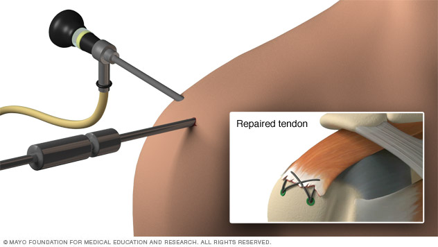 Illustration of arthroscopic tendon repair