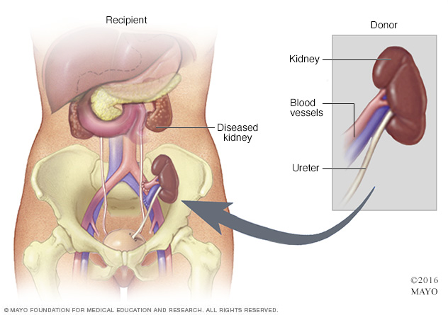 Kidney transplant